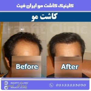 کاشت مو ایران فیت