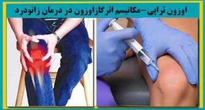 آرتروز زانو