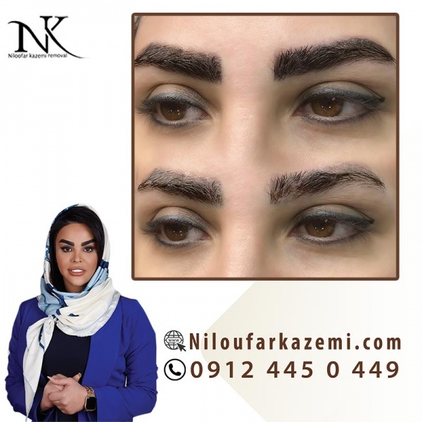 ریموو تاتو با روش های اصولی و تخصصی