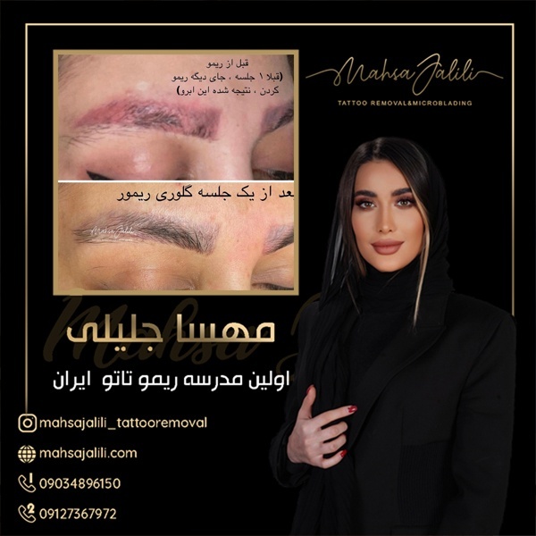 بروز ترین تکنیک ریموو تاتو در تهران