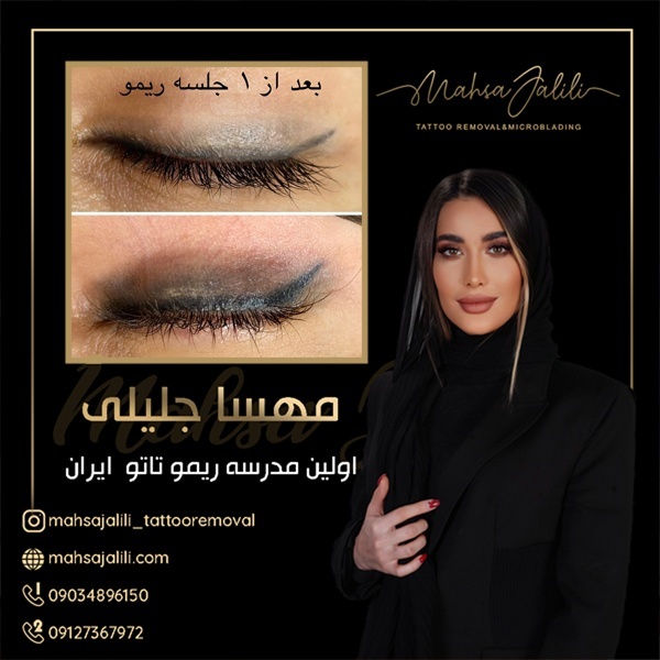 آموزش ریموو و پاک کردن تاتو اسکالپ سر با ریموور