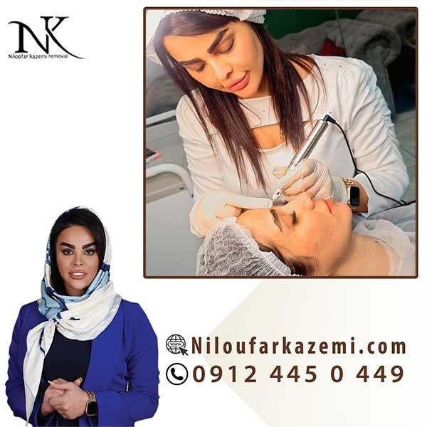 قیمت ریموو تاتو در بهترین مرکز ریموو تاتو