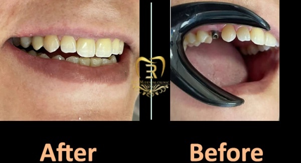 ایمپلنت دندان در رشت با بهترین قیمت و کیفیت بالا