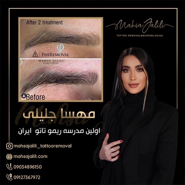 پاک کردن و ریموو تاتو بدون درد و نقاهت