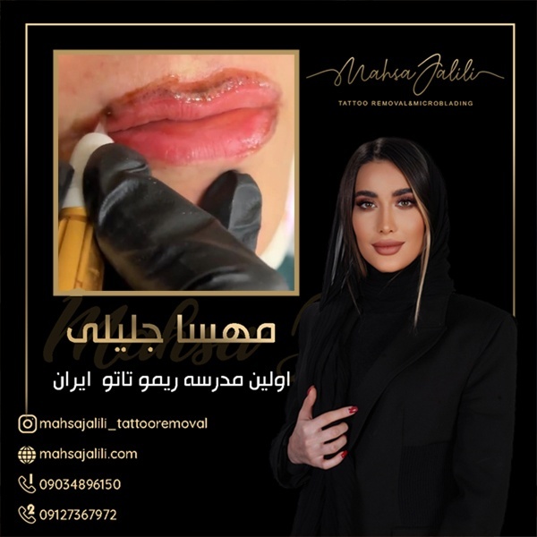 پاک کردن تاتو قدیمی با بهترین ریموور جهان
